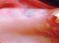 Implant Uncovering - Locate the implant for stage 2 surgery