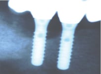 Peri-Implantitis Treatment - 60 Day post operative radiograph